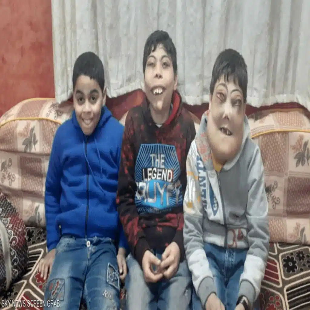 تحرك سريع من جانب الحكومة المصرية لعلاج أطفال مصابين بمرض نادر 