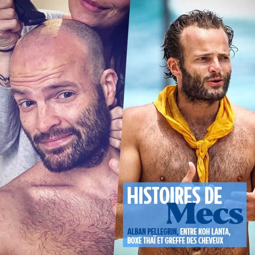 Alban Pellegrin, de Koh Lanta à sa greffe des cheveux