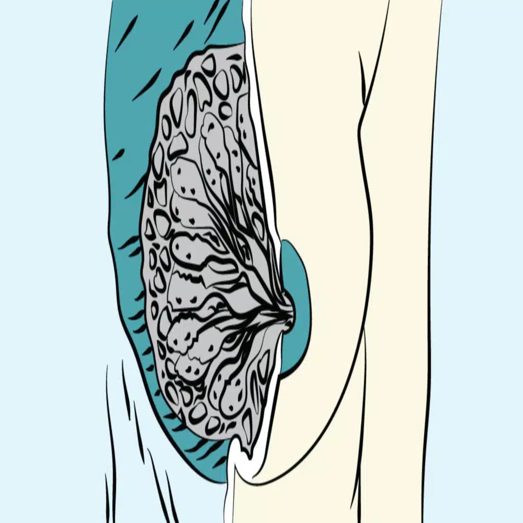 207. Approach to Breast Lumps