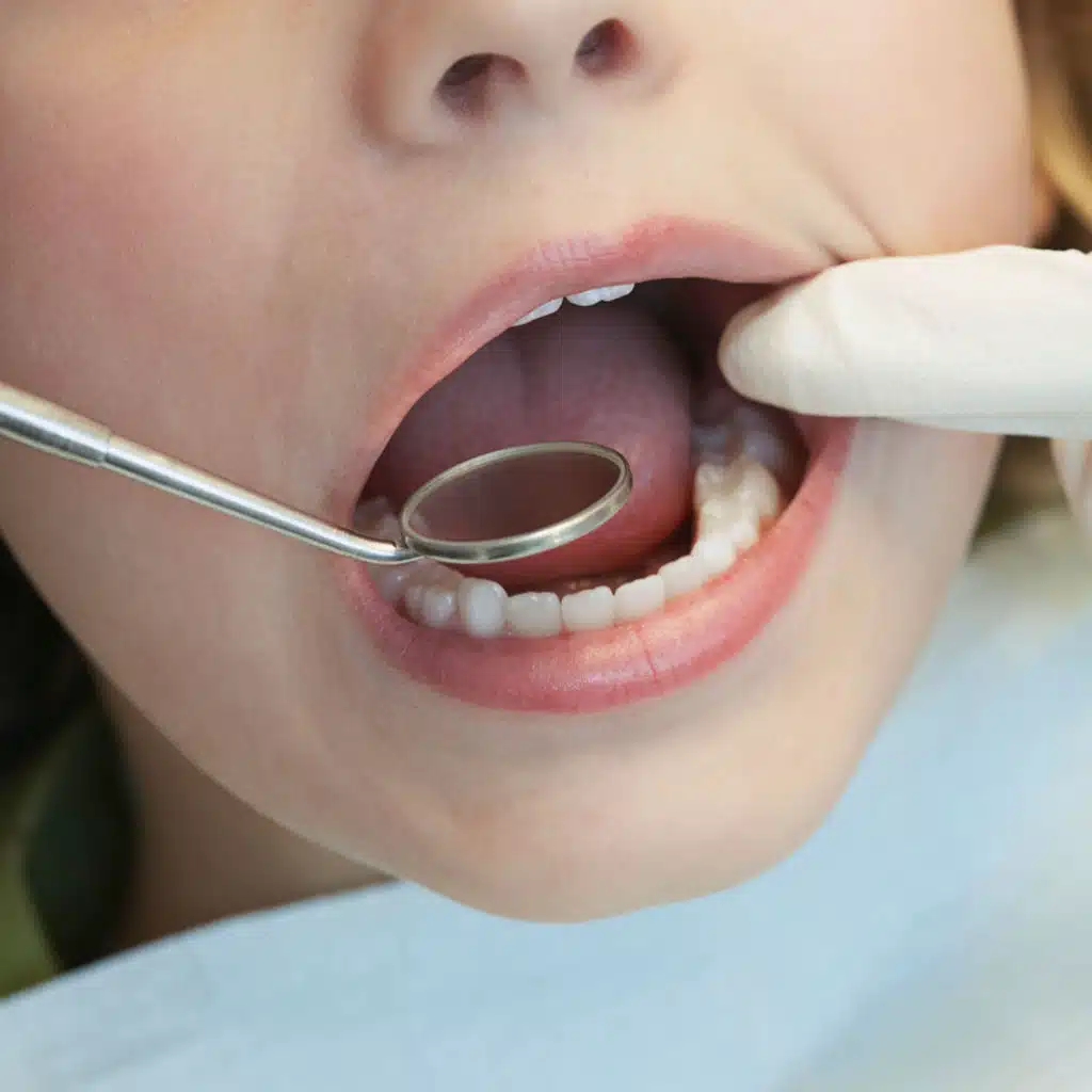USPSTF Recommendation: Screening and Interventions to Prevent Dental Caries in Children