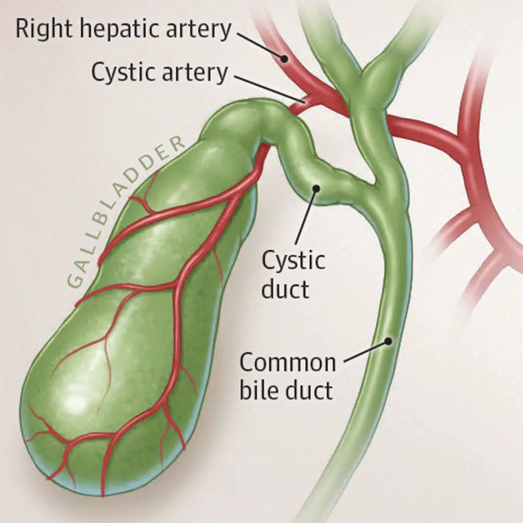 Acute Cholecystitis