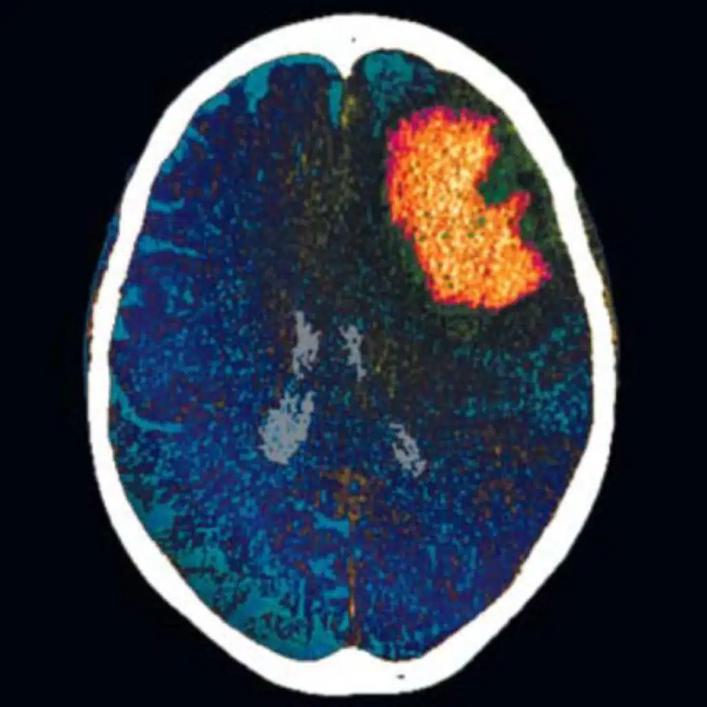 Seizure Prophylaxis After Spontaneous Intracerebral Hemorrhage