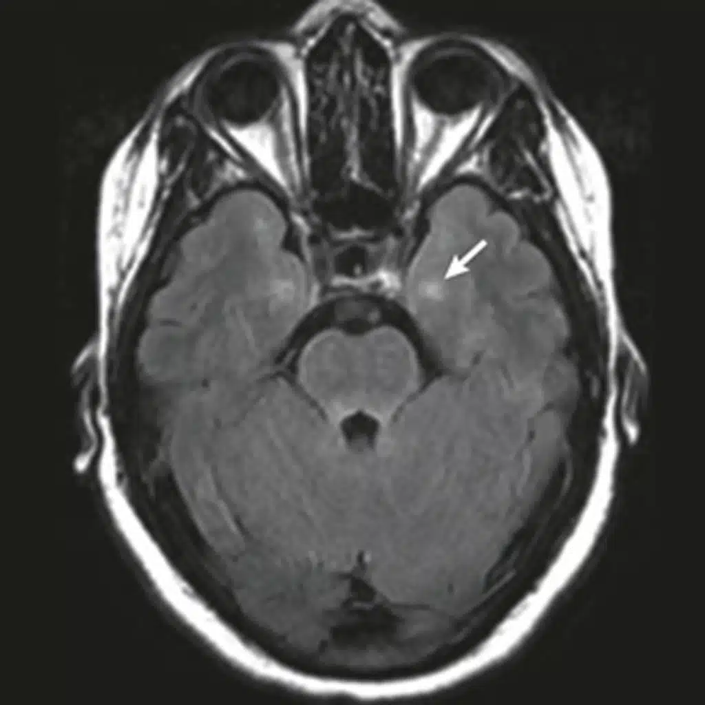 Use and Safety of Immunotherapeutic Management of N-Methyl-D-Aspartate Receptor Antibody Encephalitis