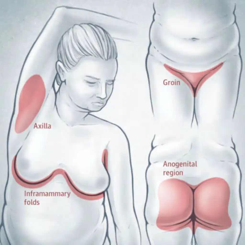 Differences Between Children and Adults With Hidradenitis Suppurativa
