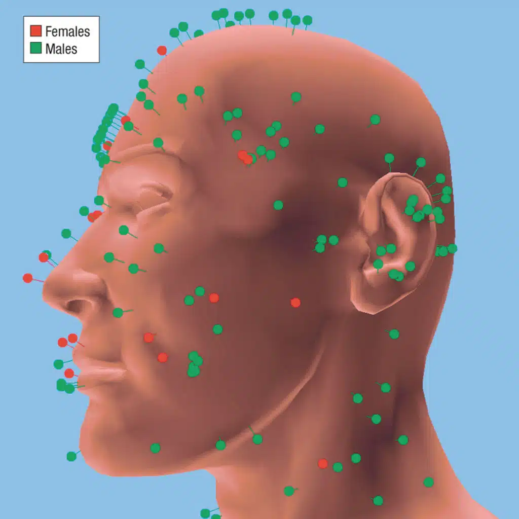 Risks of Multiple Skin Cancers in Organ Transplant Recipients
