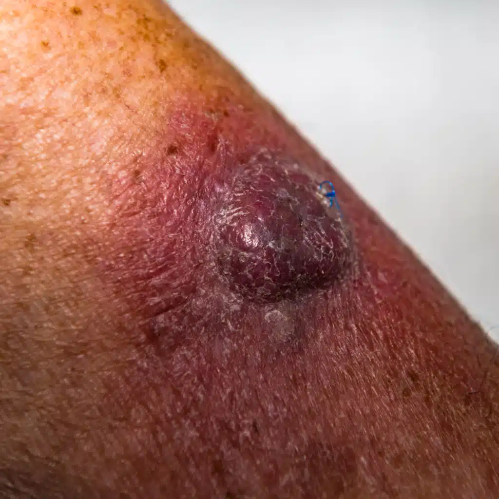 Nonkeratinocyte Skin Cancer Risk Among Solid Organ Transplant Recipients