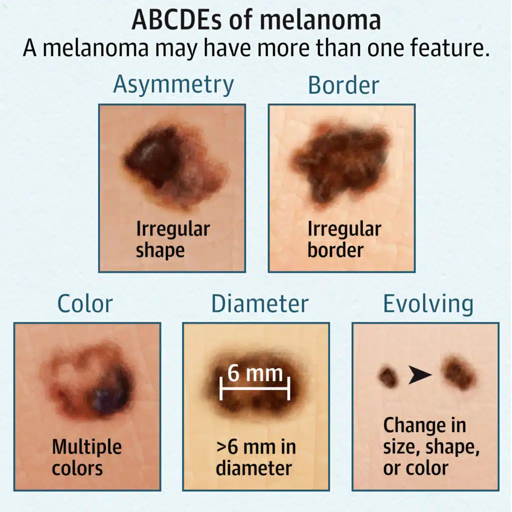 Five-Year Outcomes of a Melanoma Screening Initiative in a Large Health Care System