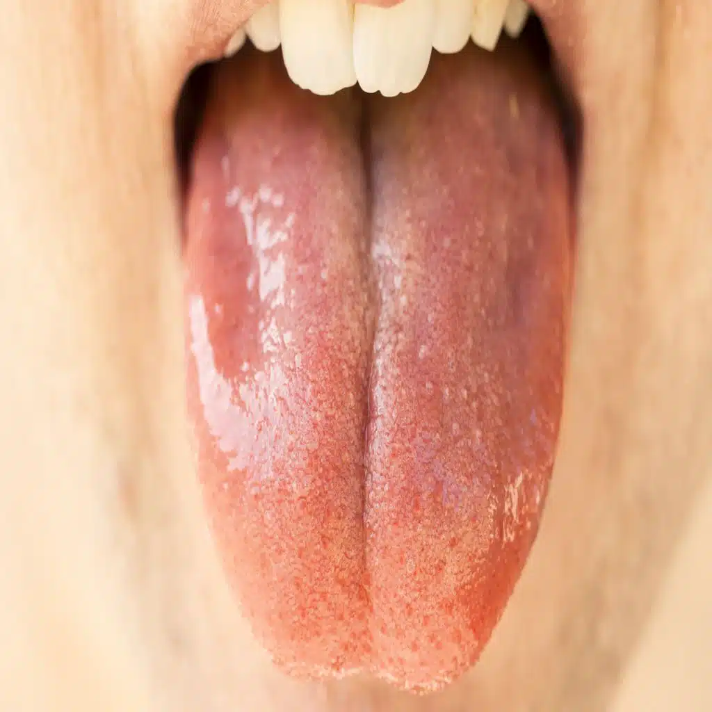 317. Oral Cavity Cancer