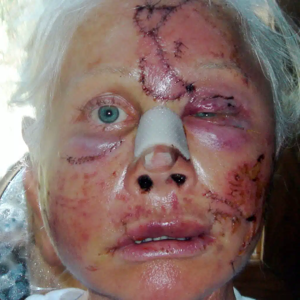 A bear ripped off my face!