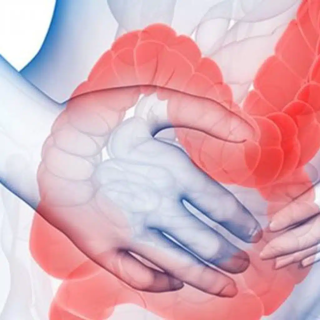 نظام الحياة الصحي يقي من التهاب الأمعاء