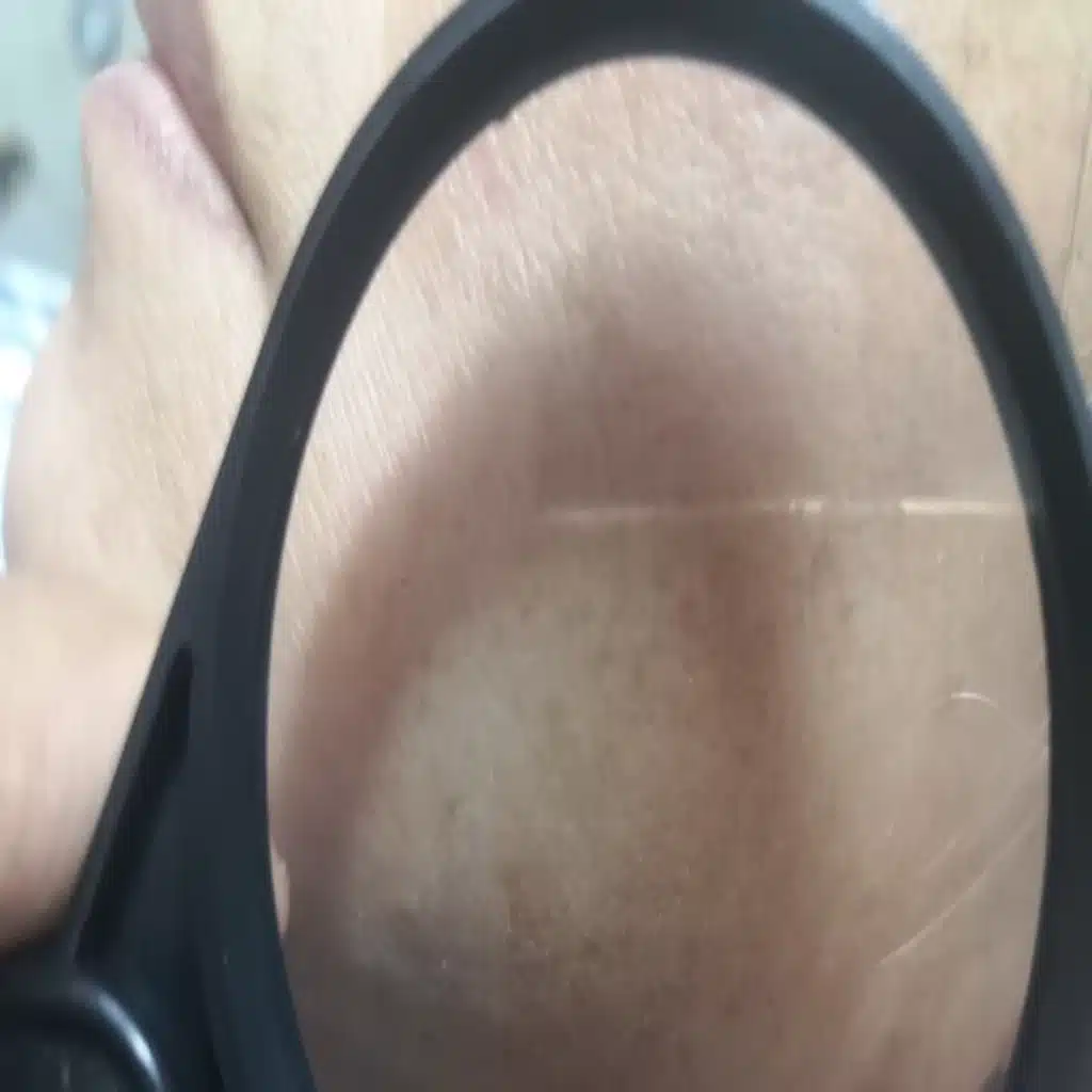 Dermaplaning, microneedling and electrolysis. Dr Rosemary Coleman talks us through non-invasive skincare tweak-ments