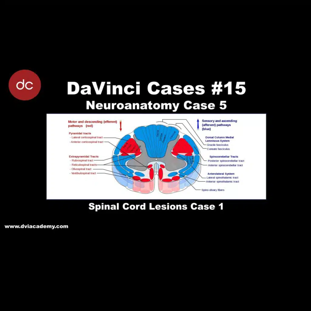 Spinal Cord Lesions 1 [#DaVinciCases - Neuroanatomy 5 - Spinal Cord Lesions Case 1]