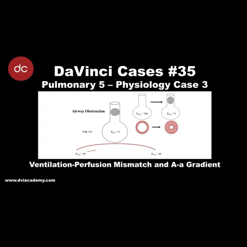 Ventilation-Perfusion Mismatch and A-a Gradient [#DaVinciCases Pulmonary 5 - Physiology Case 3]