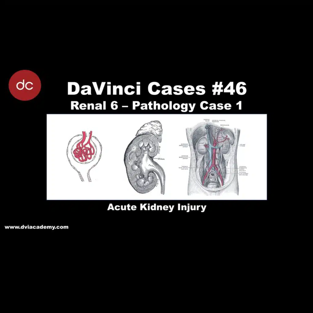 Acute Kidney Injury [#DaVinciCases Renal 6 - Pathology Case 1]