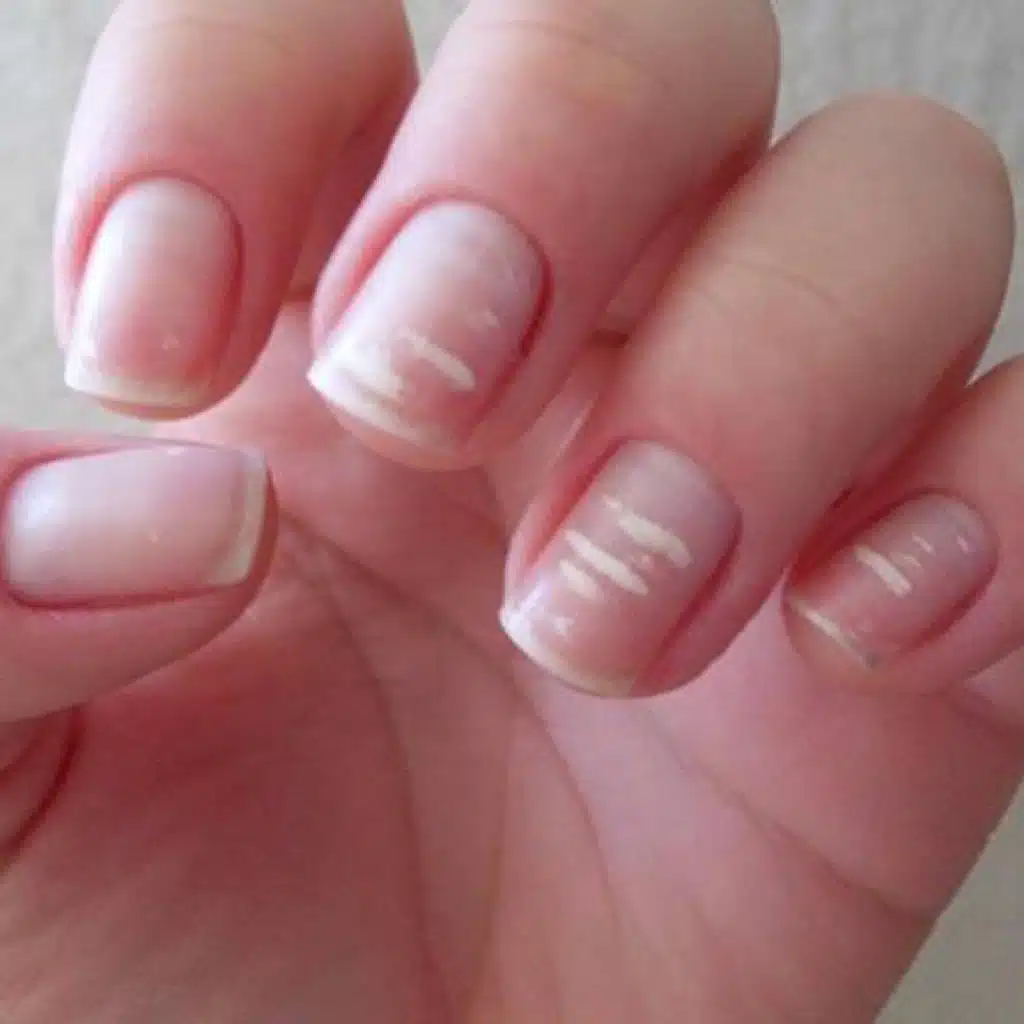 علامات في الأظافر تكشف عن أمراض صحية