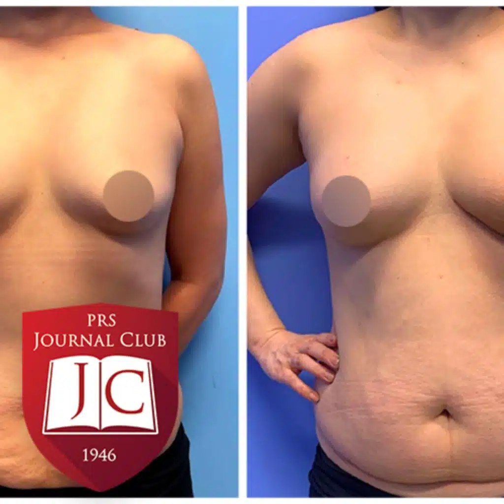 "Free SLAM Flap" with Ketan Patel, MD  - Nov. 2023 Journal Club