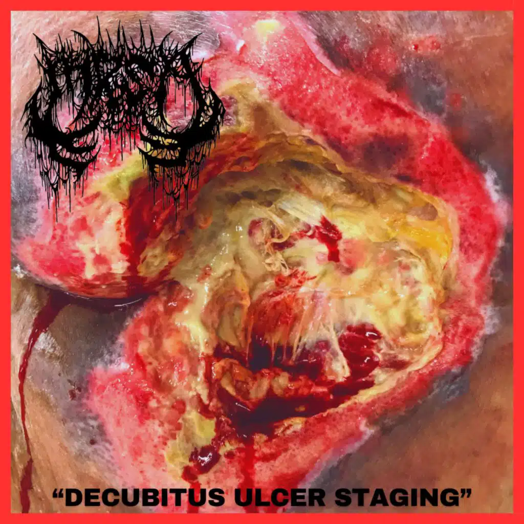 Decubitus Ulcer Staging