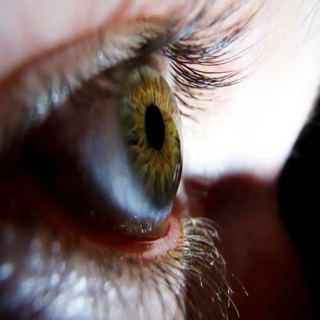 399. Corneal Transplant