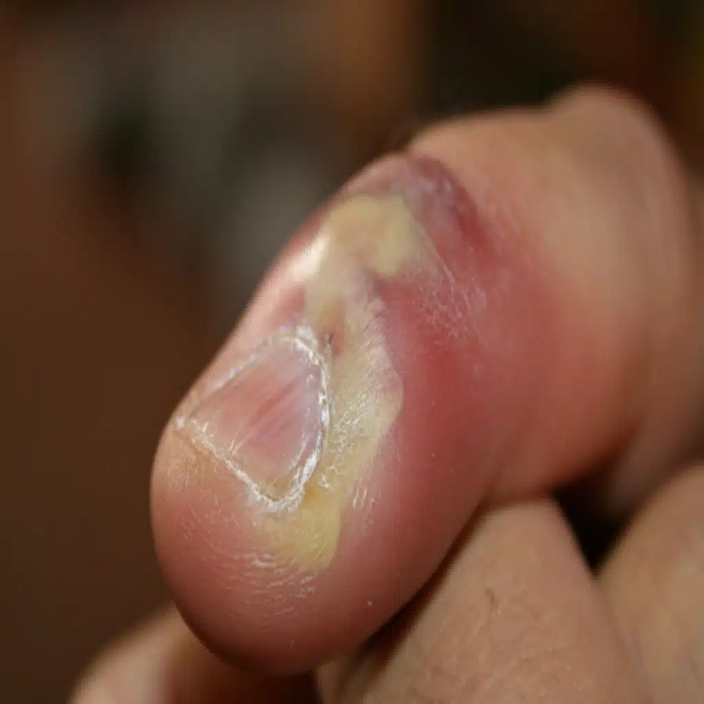 403. Herpetic Whitlow Infection