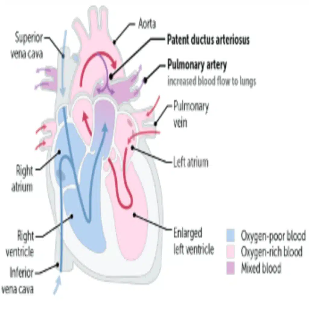 Patent Ductus Arteriosis