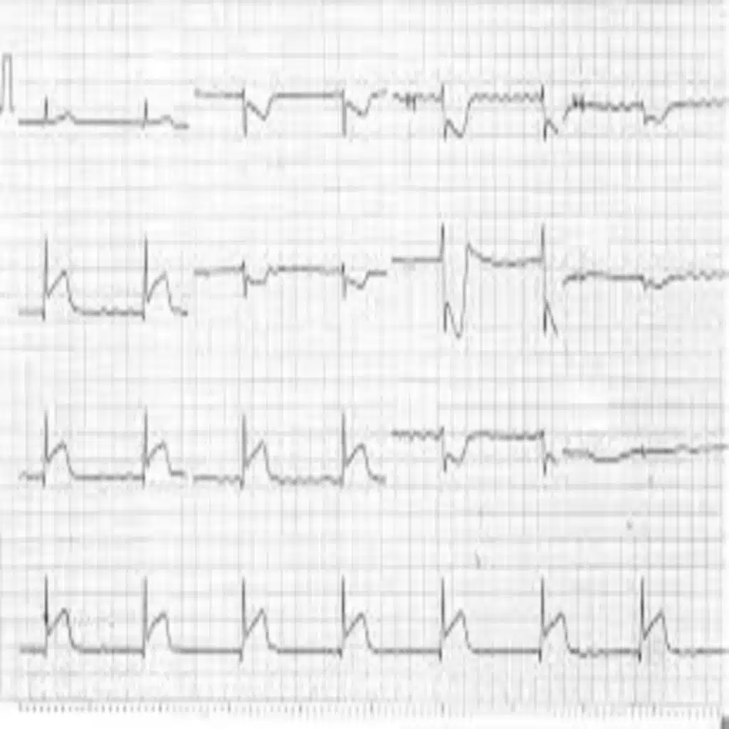 Podcast 826: STEMI Equivalents