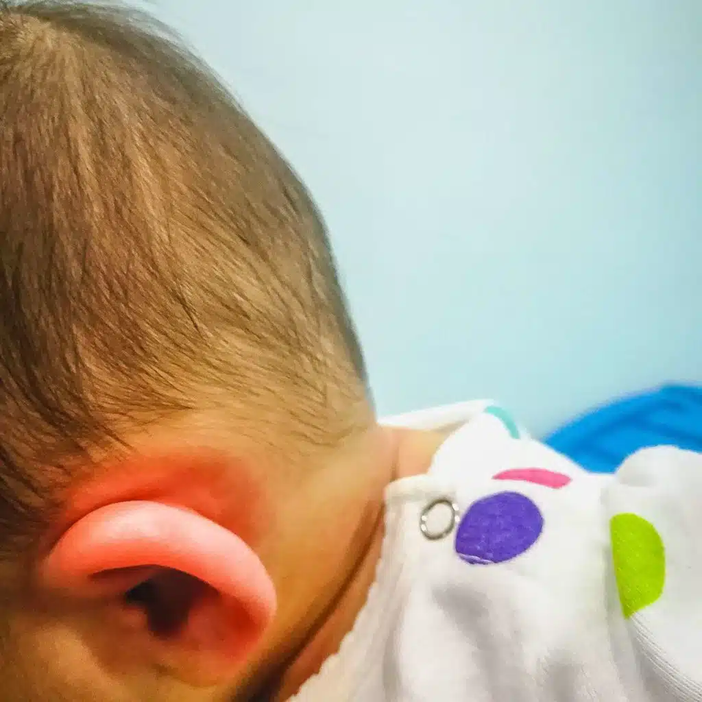 التهابات الأذن الوسطى المتكررة