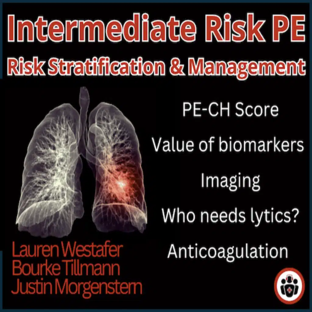 Ep 203 Intermediate Risk Pulmonary Embolism Risk Stratification, Management and Algorithm