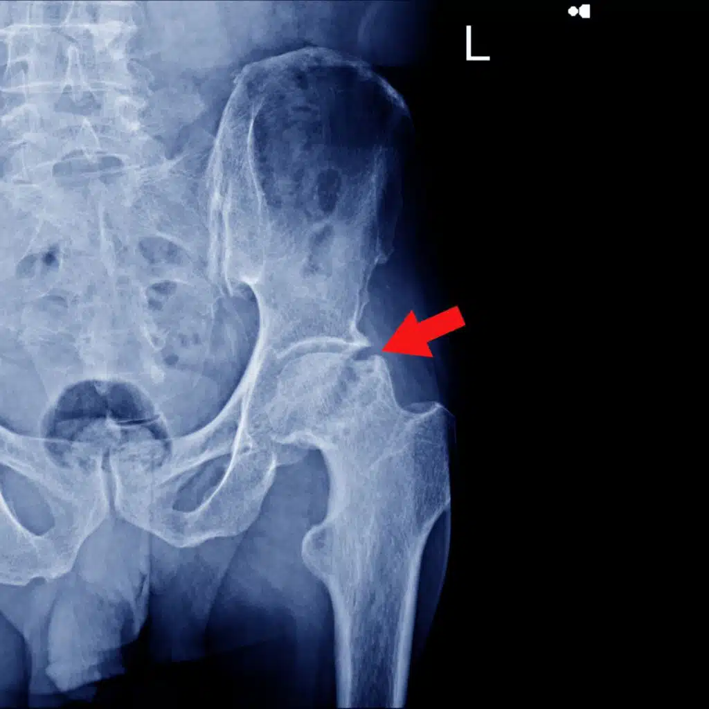 Episode #345: Hip Pain, What Do? (Assessment, Plan,  and Monitoring)