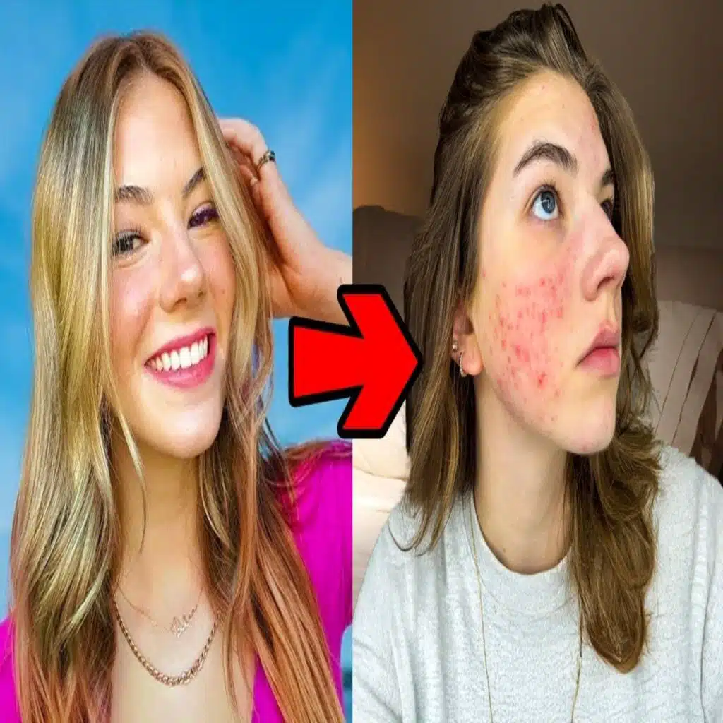 Acne Is Ruining My Life!