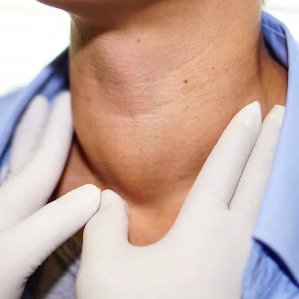 Thyroid Emergencies