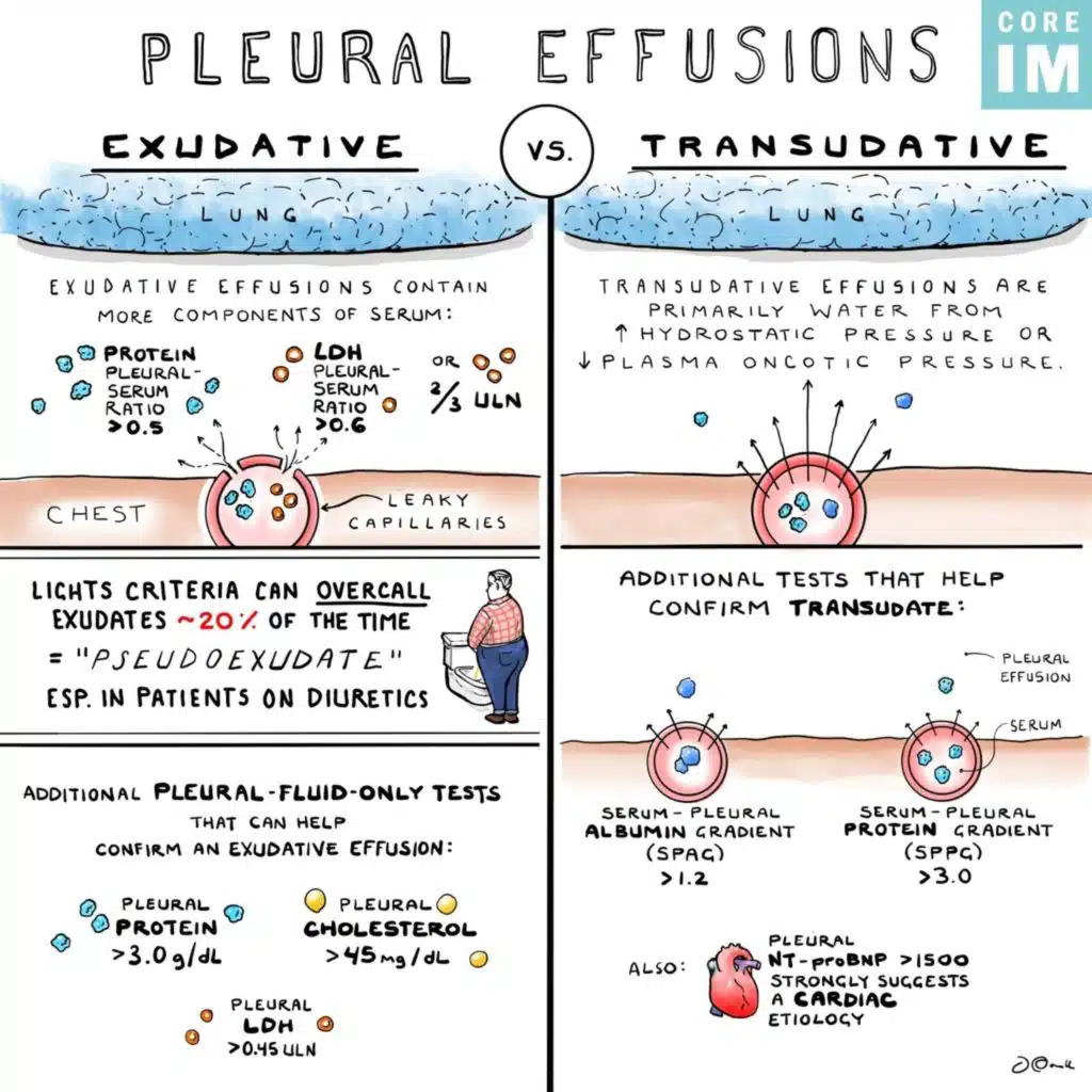 #182 Pleural Effusions: 5 Pearls Segment