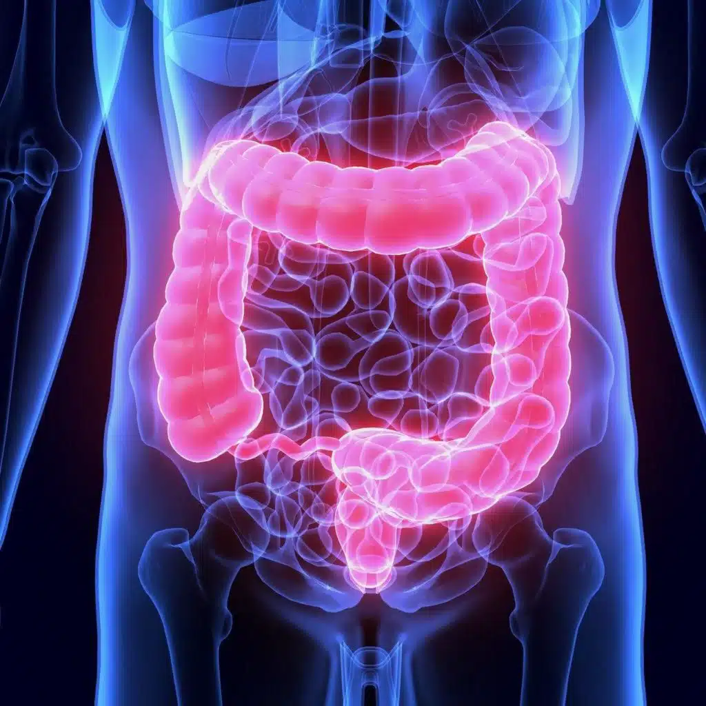 Diverticular Disease