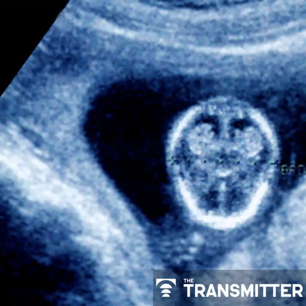 Gene-activity map of developing brain reveals new clues about autism's sex bias