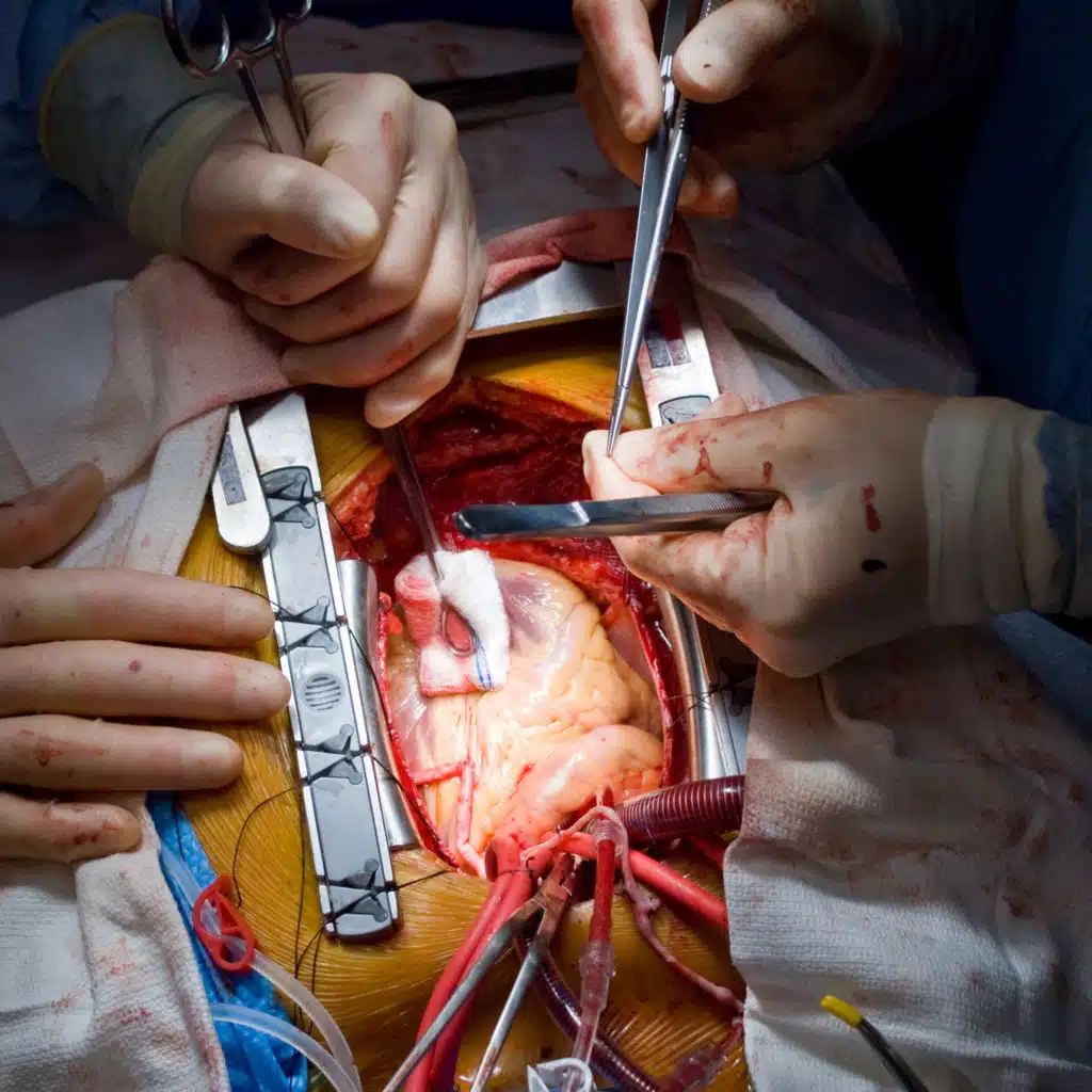 Long-term Clinical Outcomes of Skeletonized vs Pedicled Internal Thoracic Artery Harvesting in the ART Trial