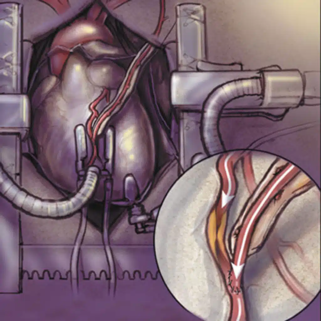Sex Differences in Multiple vs Single Arterial Grafting