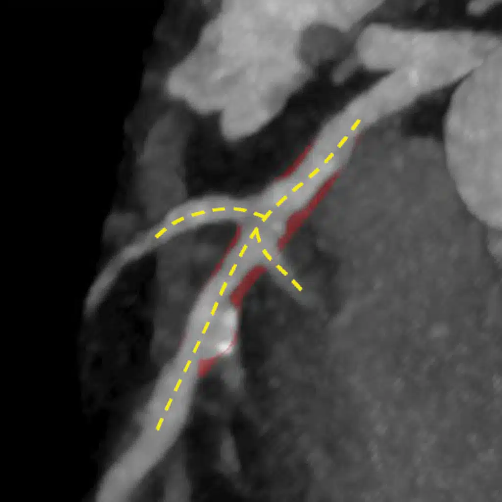 Association of Plaque Location and Vessel Geometry With Future ACS–Causing Culprit Lesions