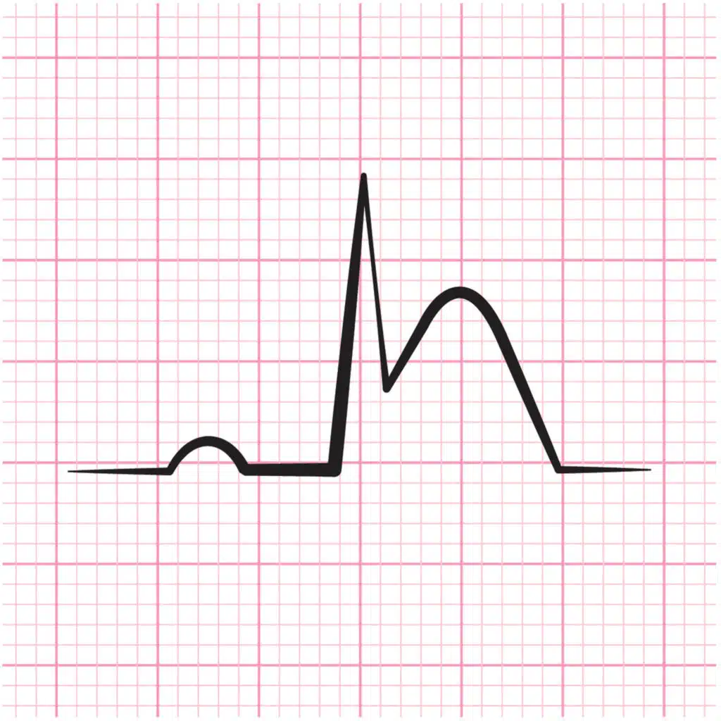 Performance of Guideline-Recommended Strategies for Hospitalized Patients With STEMI in China