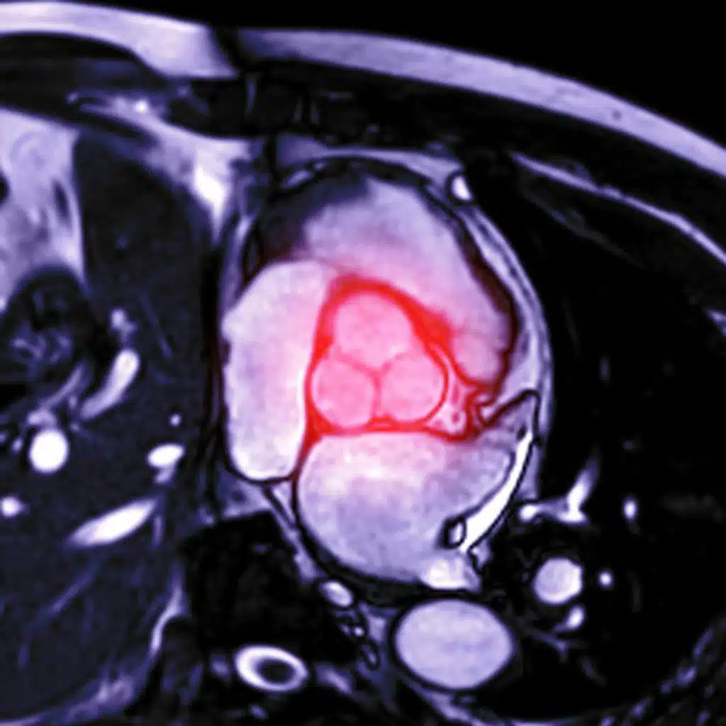 Association of Myocardial Blood Flow Reserve With Adverse Left Ventricular Remodeling in Patients With Aortic Stenosis