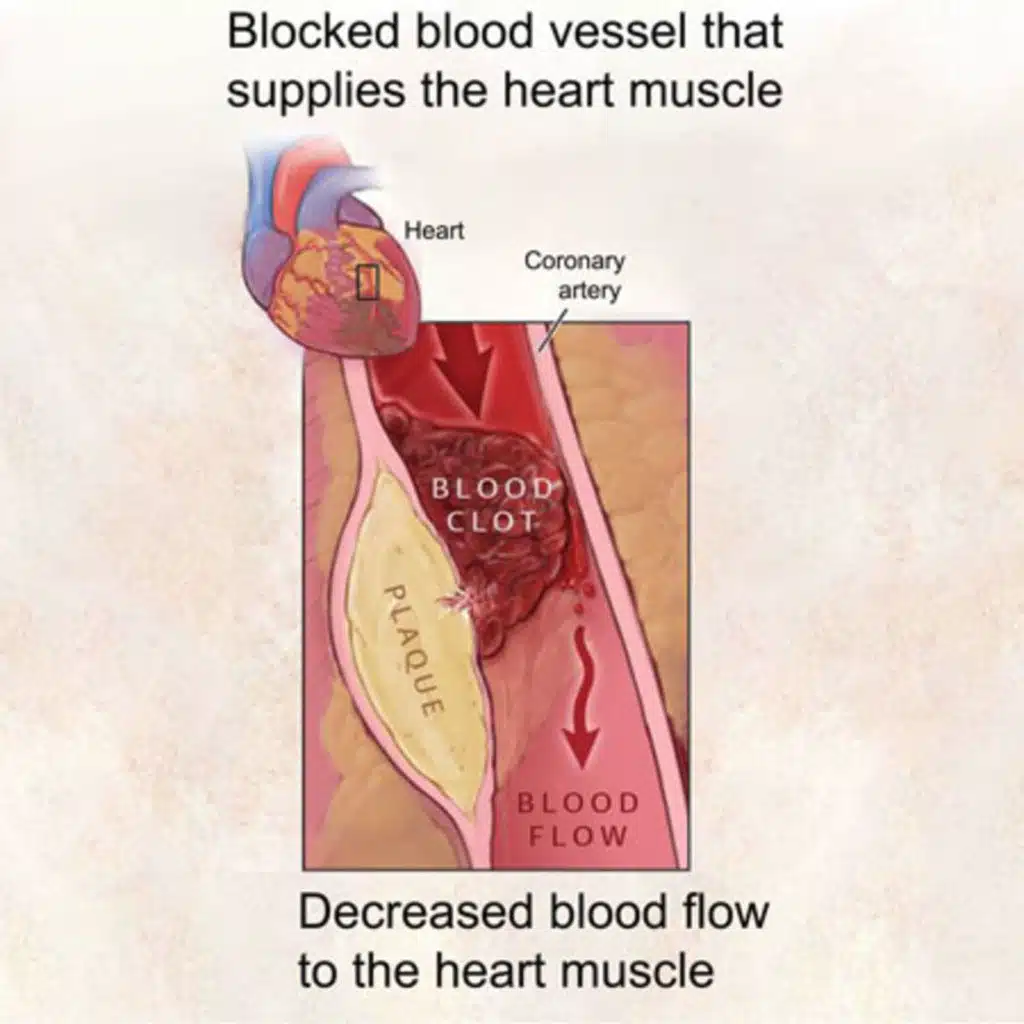 Association of Socioeconomic Disadvantage With Long-term Mortality After Myocardial Infarction