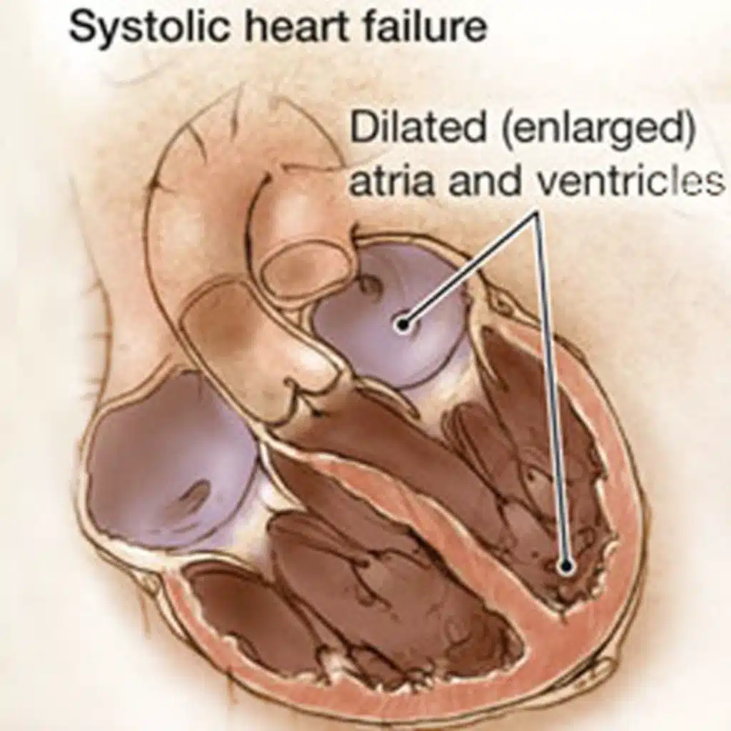 New York Heart Association Class vs Patient-Reported Outcomes in Heart Failure