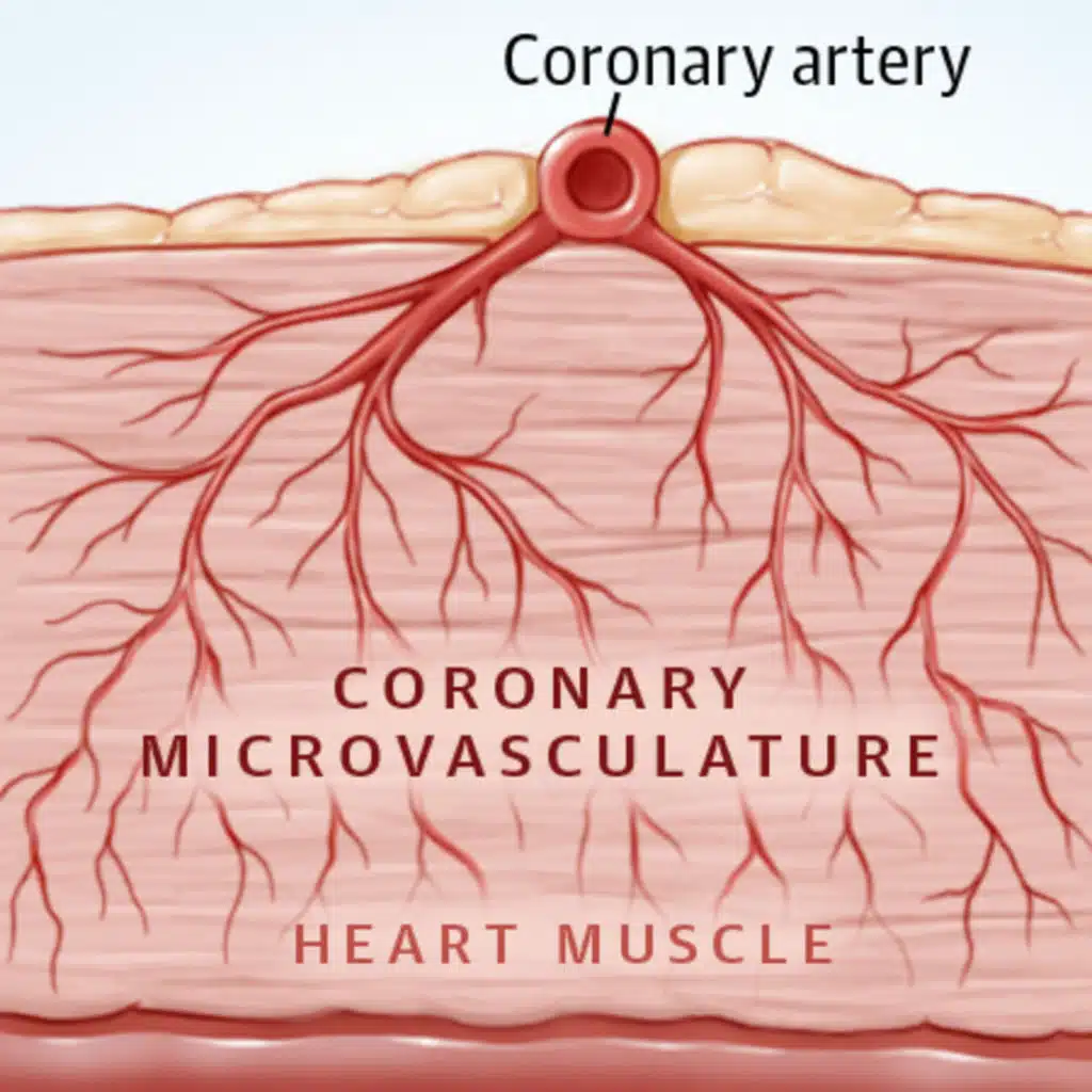 Prevalence of Coronary Artery Disease and Coronary Microvascular Dysfunction in Heart Failure