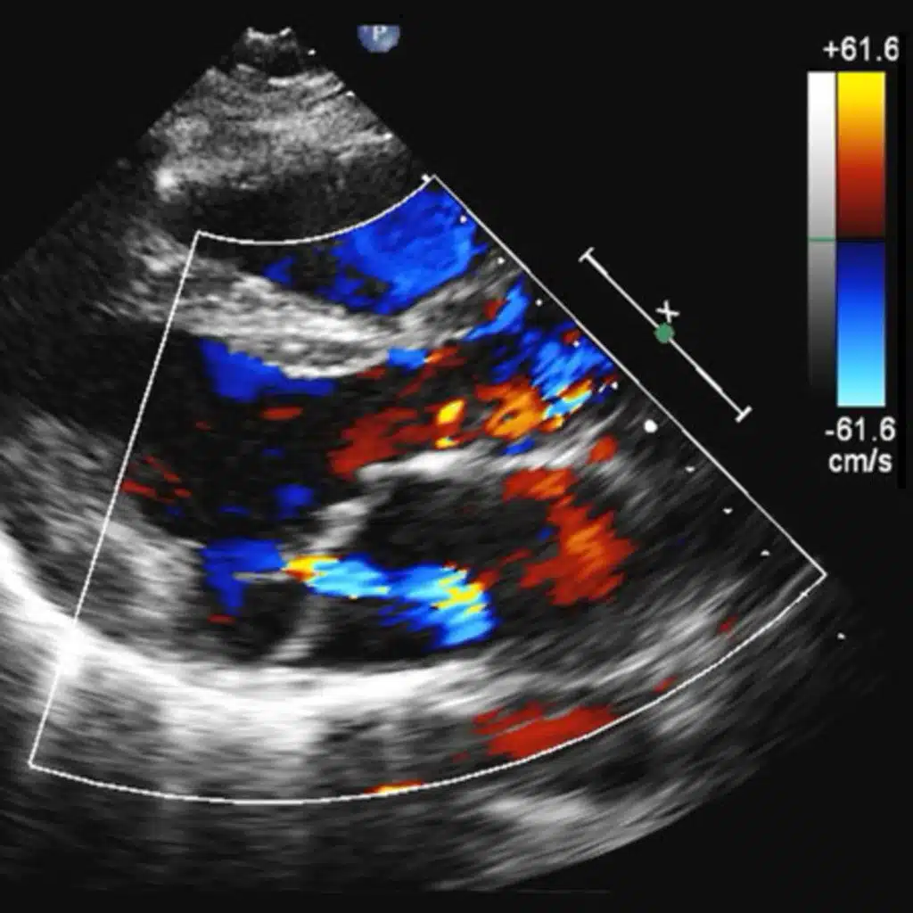 Systematic Echocardiographic Screening for Rheumatic Heart Disease in Nepalese Schoolchildren
