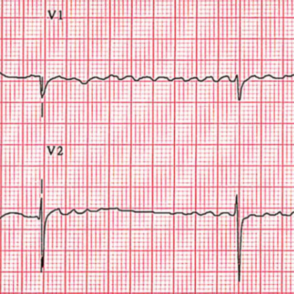 Association of Rare Genetic Variants and Early-Onset Atrial Fibrillation in Ethnic Minority Individuals