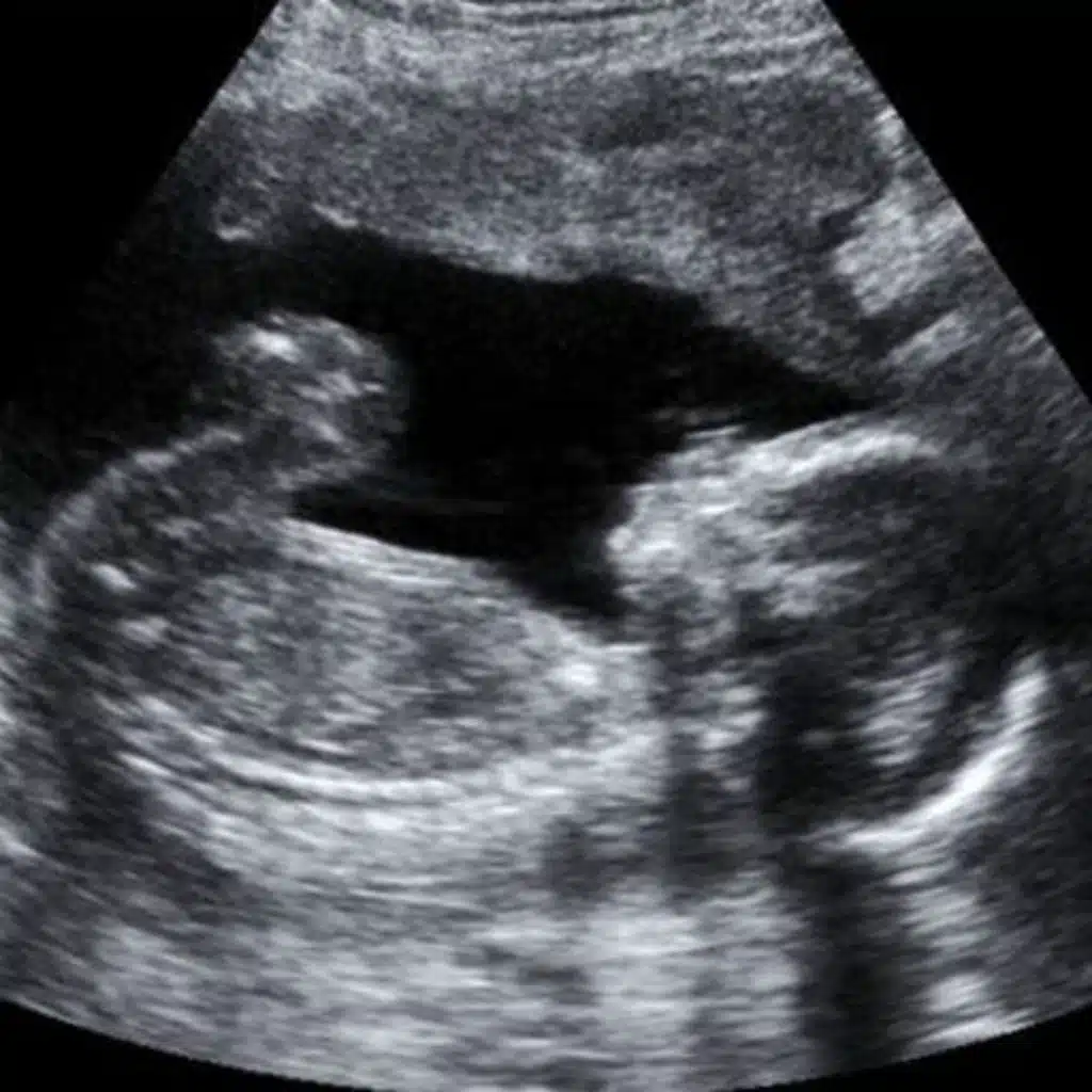 Seeking Support: Miscarriage and Infant Loss