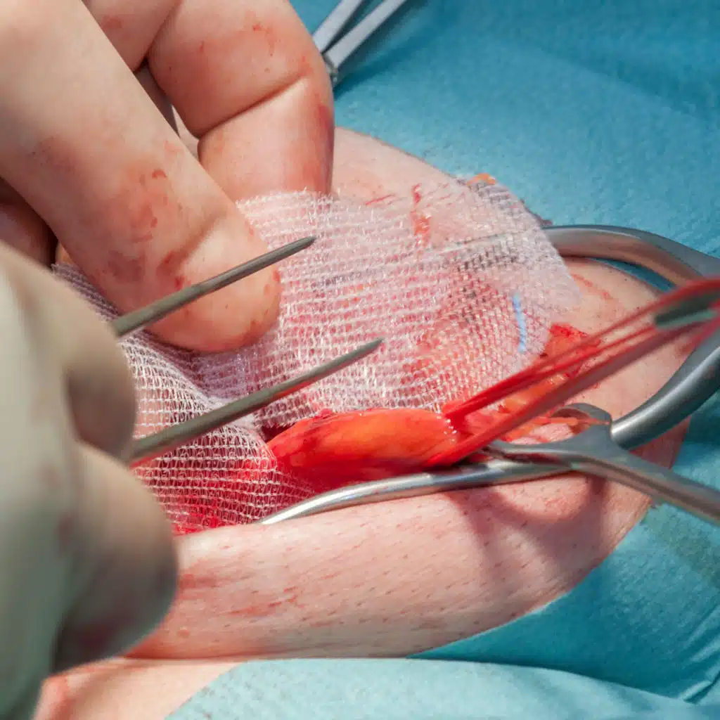 Biologic vs Synthetic Mesh for Single-stage Repair of Contaminated Ventral Hernias