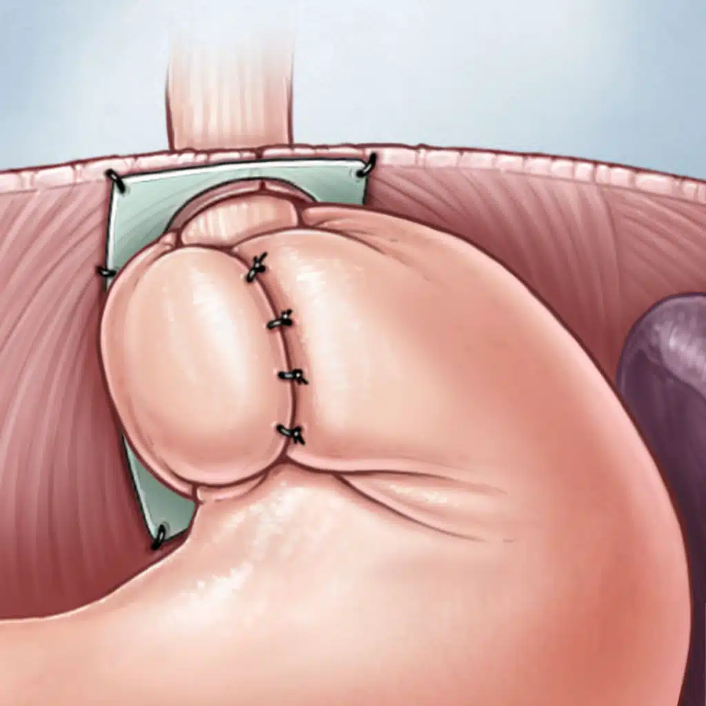 Comparable Clinical Outcomes of Partial vs Total Fundoplication