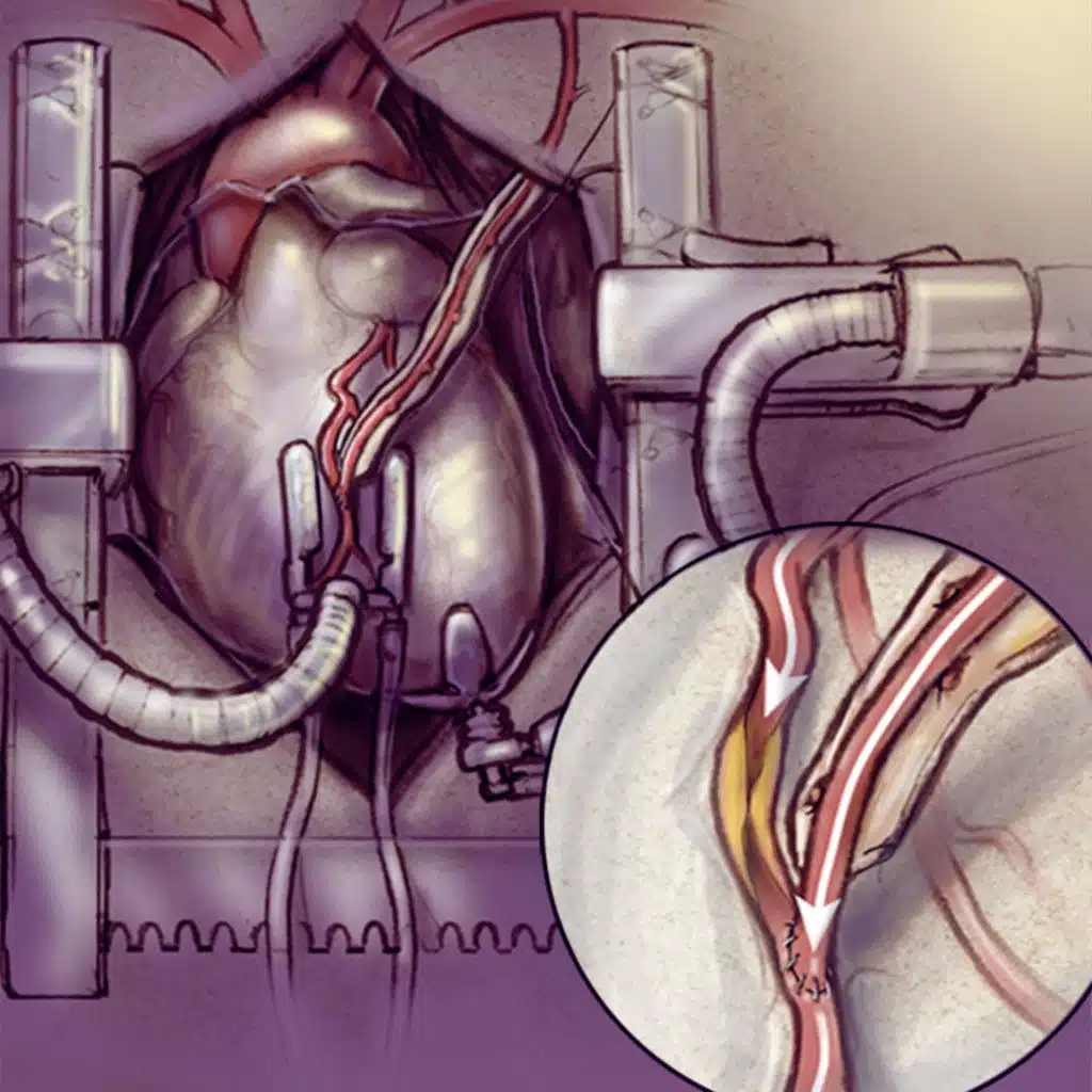 Ten-Year Outcomes of Off-Pump vs On-Pump Coronary Artery Bypass Grafting in US Department of Veterans Affairs