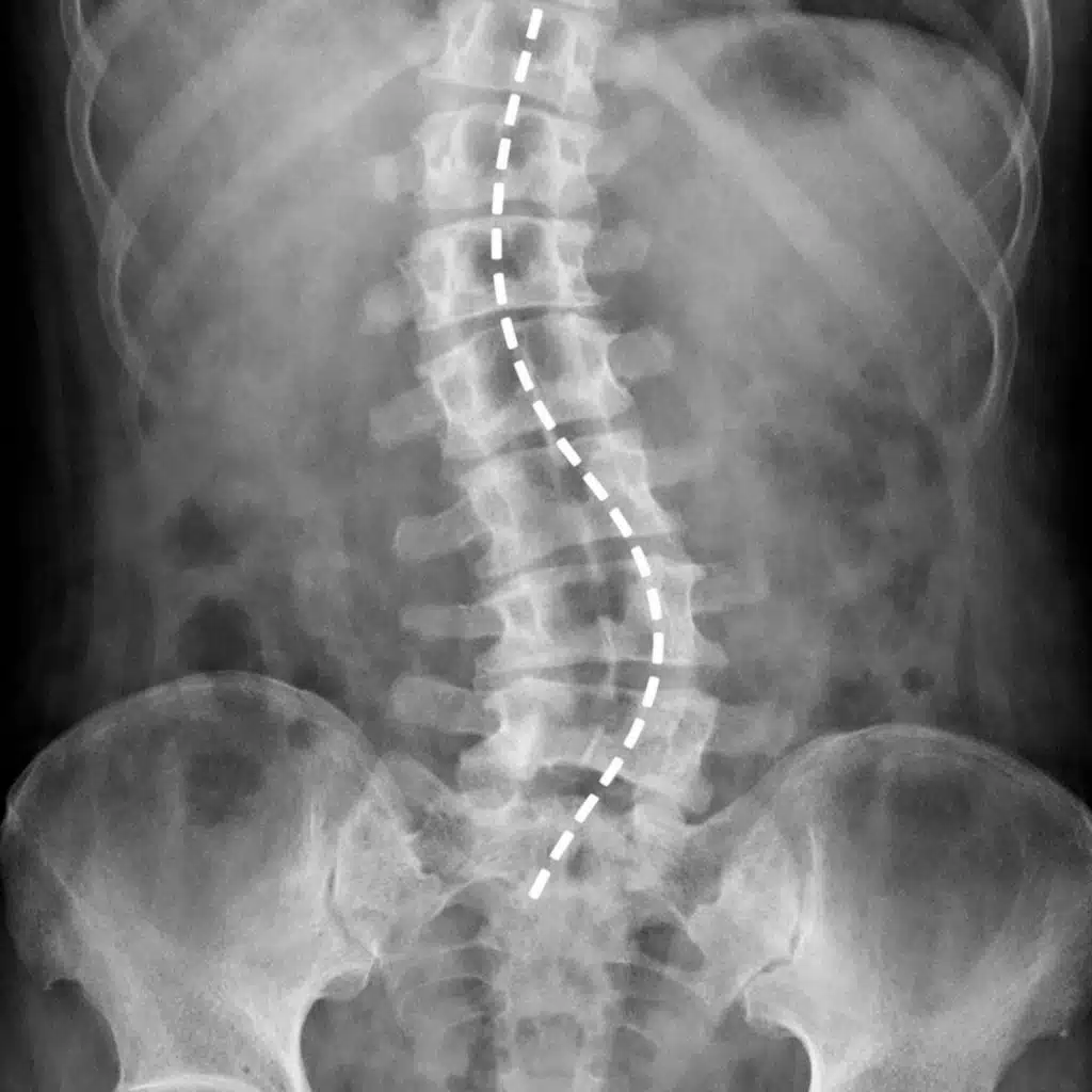 TENGO LA COLUNA DEVIA