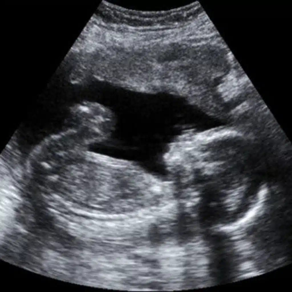Miscarriage and Stillbirth: Dealing with Loss