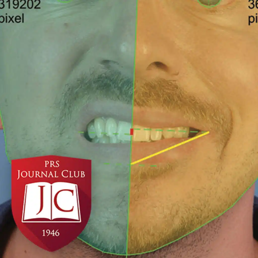 "Flap Debulking after Facial Reanimation" with Shai Rozen, MD - Jan. 2026 Journal Club